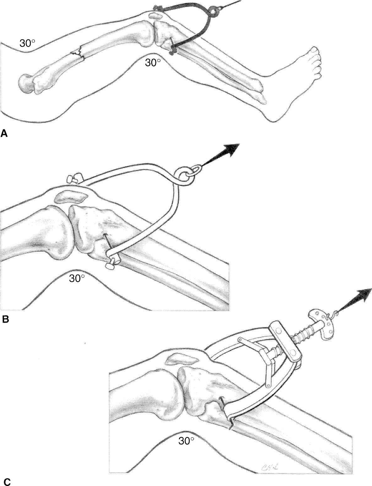 Traction  Musculoskeletal Key