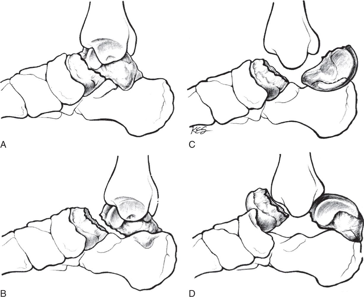 types of talus fractures