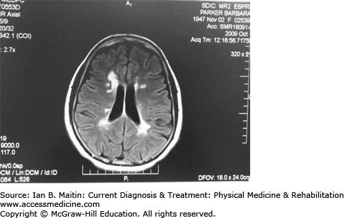Multiple Sclerosis Musculoskeletal Key Multiple Sclerosis Musculoskeletal Key