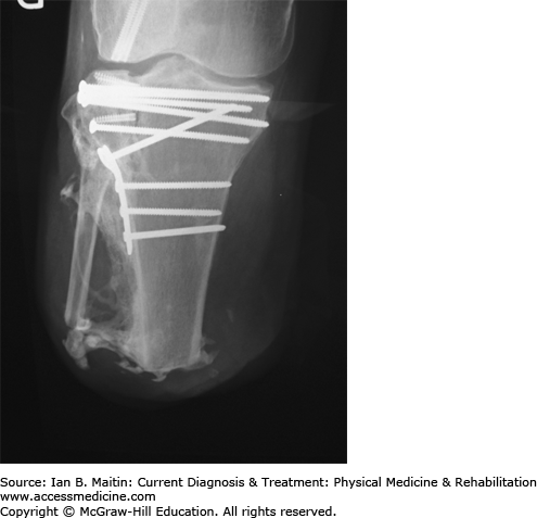 Lower Limb Amputation, Rehabilitation, & Prosthetic Restoration ...