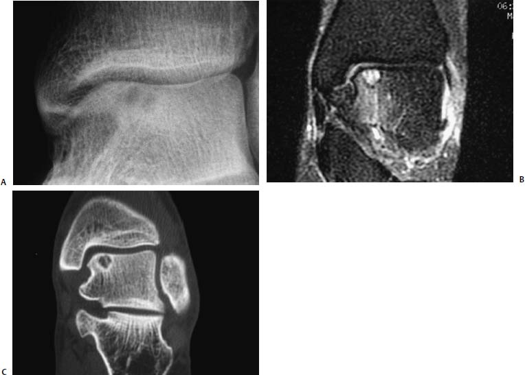 Talus Bone Mri At Cristina Lee Blog Talus Bone Mri At Cristina Lee Blog