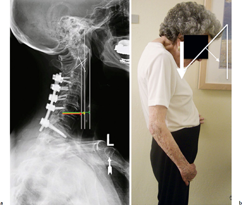 Cervical Sagittal Balance: What Is Normal and What Is the Effect on  Reconstruction Outcomes