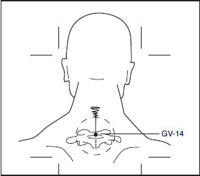 Gv 14 Da Zhui Big Vertebrae Central Reunion Point Musculoskeletal Key