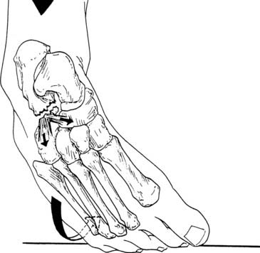 anterior calcaneus fracture