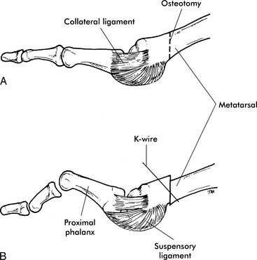 Lesser-Toe Disorders | Musculoskeletal Key