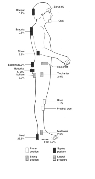 Treatment of a category II pressure ulcer and improved asymmetric