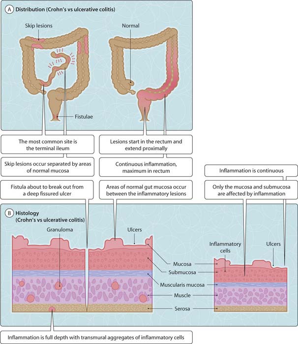 Crohn’s disease Musculoskeletal Key