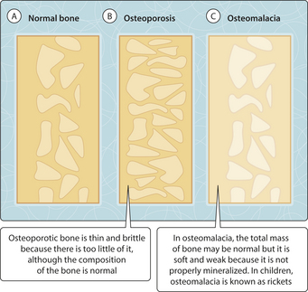 osteomalacia bone