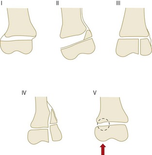 salter harris fracture classification