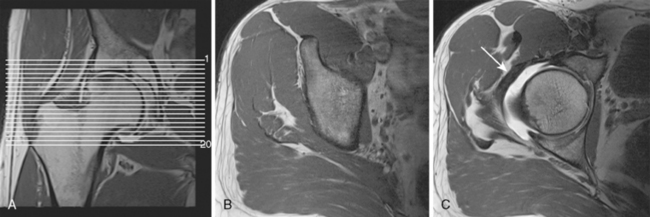 c# key generate Joint Magnetic of the   Key Musculoskeletal Resonance Imaging Hip