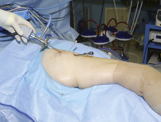 Iliotibial band lengthening (for ITB friction syndrome) Surgical Technique  - OrthOracle
