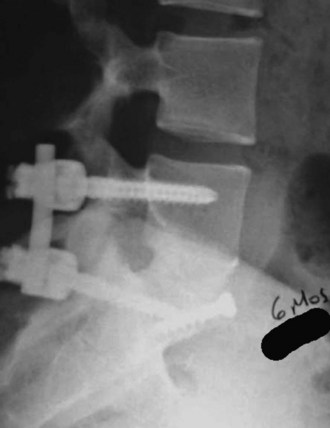 Anterior Lumbar Interbody Fusion Musculoskeletal Key