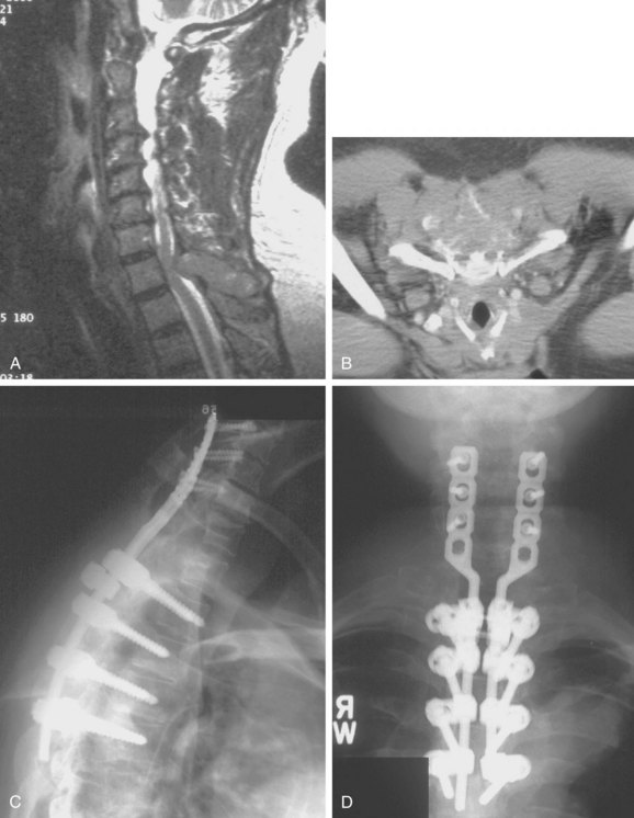 Osteochondroma-Related Pressure Erosions in Bony Rings Below the Waist