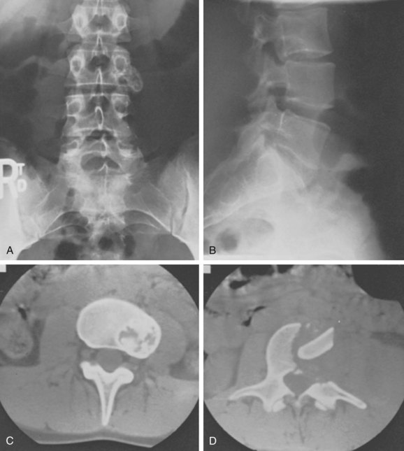 Osteochondroma-Related Pressure Erosions in Bony Rings Below the Waist