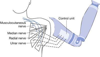 Rehabilitation And Prosthetic Restoration In Upper Limb Amputation ...