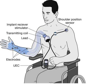 electrode placement for russian electrical stimulation for shoulder and  elbow - Yahoo Image Search Results