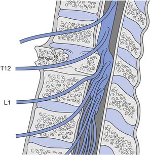 Case Report Conus Medullaris Syndrome From Spinal