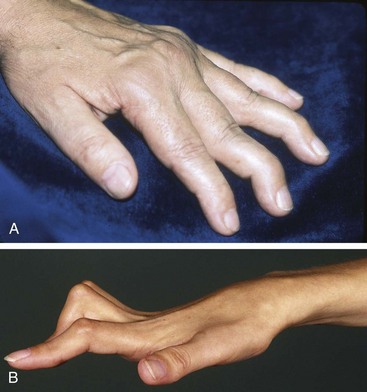 rheumatoid arthrosis hatékony kezelés