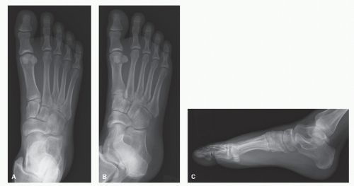 oblique fracture 5th metatarsal