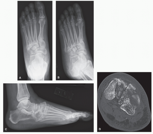 midfoot fracture