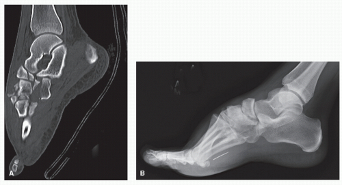 midfoot fracture