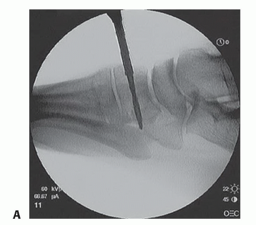 Reconstruction Of Tibialis Anterior Tendon Ruptures Musculoskeletal Key