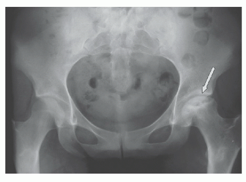 Nontraumatic Osteonecrosis of the Femoral Head | Musculoskeletal Key