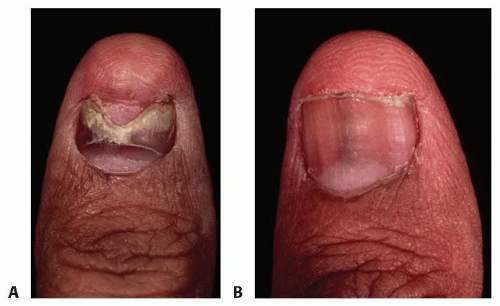Above Partial fingernail defect after trauma Center Excision of   Download Scientific Diagram
