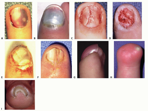 Surgical & Cosmetic Dermatology | Intraoperative dermoscopy as a tool in  the diagnosis of melanonychia