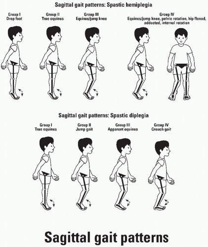 Hemiparetic Gait  Musculoskeletal Key