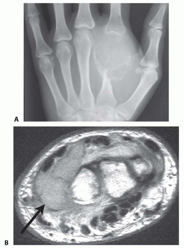 Treatment Of Enchondroma Bone Cyst And Giant Cell Tumor Of The Distal Treatment Of Enchondroma Bone Cyst And Giant Cell Tumor Of The Distal