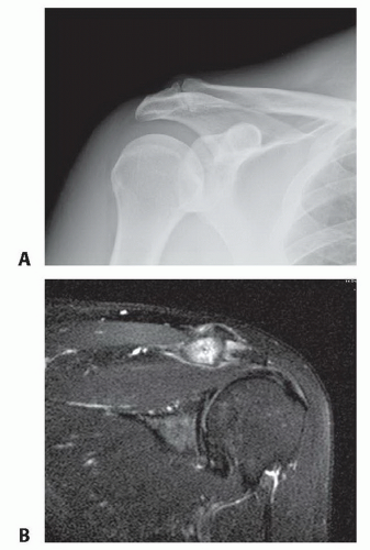 Hypertrophic Change Acromioclavicular Joint