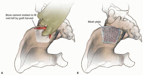 Iliac Crest Bone Graft Harvesting | Musculoskeletal Key