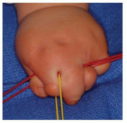 Amniotic Band Syndrome Musculoskeletal Key