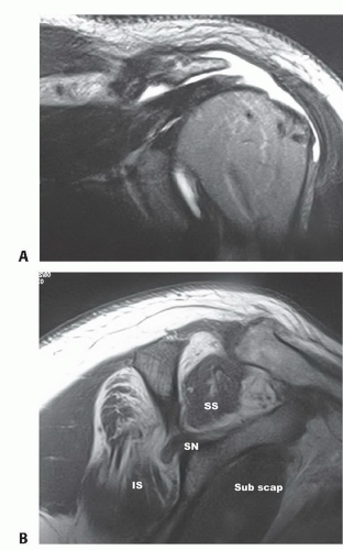 Latissimus Transfer in the Setting of Irreparable Posterosuperior ...