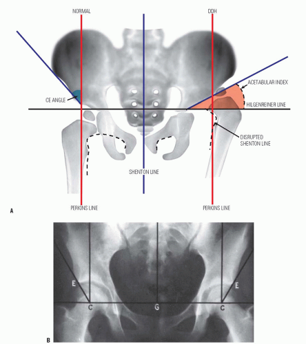 Developmental Hip Dysplasia And Dislocation Musculoskeletal Key Developmental Hip Dysplasia And Dislocation Musculoskeletal Key