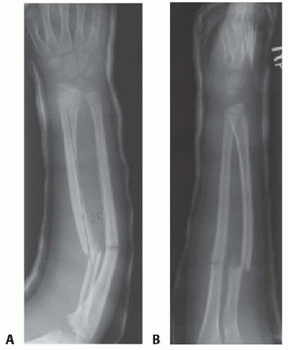 icd 10 code for left displaced tibial shaft fracture