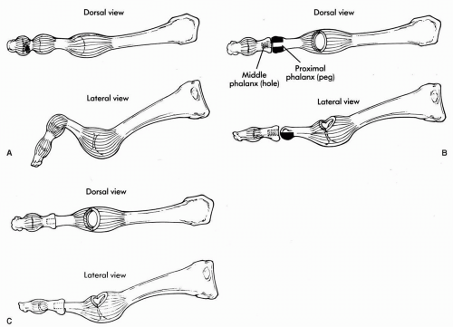 Lesser Ray Deformities | Musculoskeletal Key