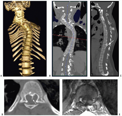 Imaging in the Diagnosis and Monitoring of Children with Idiopathic  Scoliosis. - Abstract - Europe PMC