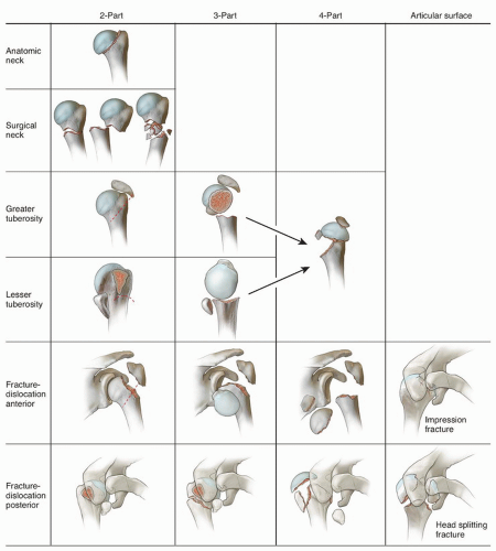 Proximal Humerus Fracture Exercises