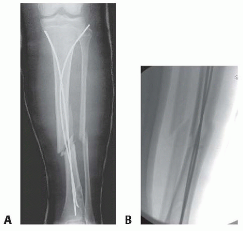 Pediatric Tibial Fractures Musculoskeletal Key Pediatric Tibial Fractures Musculoskeletal Key