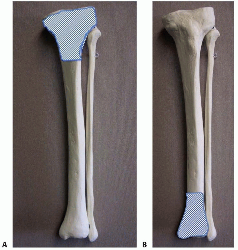 Intramedullary Nailing of Metaphyseal Proximal and Distal Fractures of