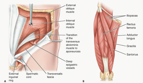 ATHLETIC PUBALGIA - 📝A sports hernia is a painful, soft tissue