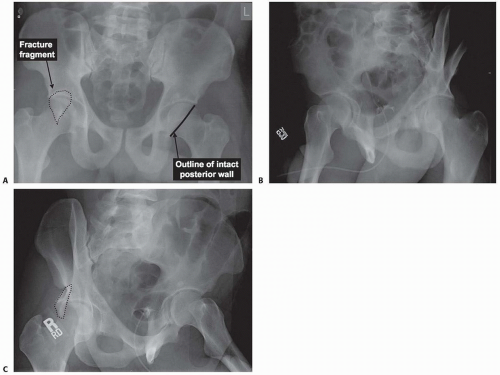 open-reduction-and-internal-fixation-of-the-posterior-wall-of-the