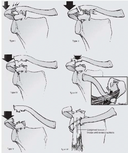 Acromioclavicular Separations: Arthroscopic Reconstruction of The ...