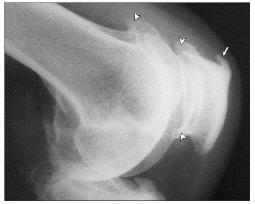 Features Of Osteoarthritis At Specific Sites Musculoskeletal Key