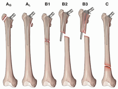 Periprosthetic Fractures Of The Femur After Total Kne - vrogue.co