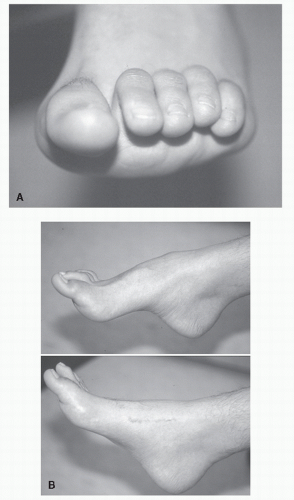 Pes Cavus Surgery | Musculoskeletal Key