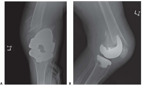 Figure 3 From Periprosthetic Fracture Following Total - vrogue.co