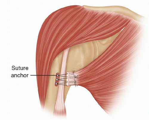 Pectoralis Major Repair | Musculoskeletal Key